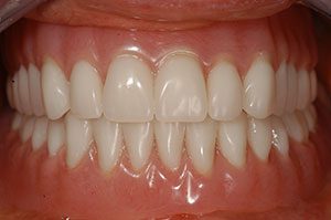 New Dentures - After