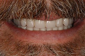 Immediate Dentures - After