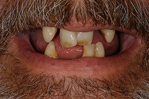 Immediate Dentures - Before