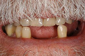 Removable Partial Denture - Before
