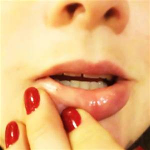 Canker Sore