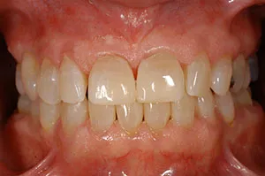 Patient's mouth after bonding to close spaces between teeth