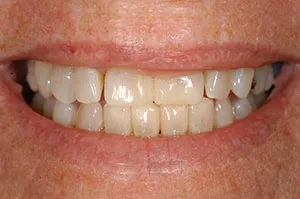 Patient's mouth after bonding to close spaces between teeth