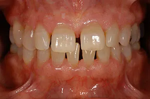 Patient's mouth before bonding to close spaces between teeth