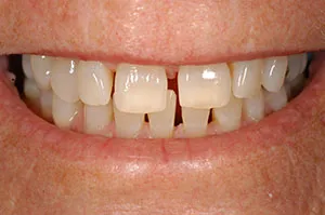 Patient's mouth before bonding to close spaces between teeth