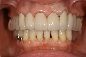 Patient's mouth after bridgework to replace a removable partial denture