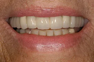 Patient's mouth after bridgework to replace a removable partial denture