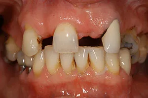 Patient's mouth before bridgework to replace a removable partial denture