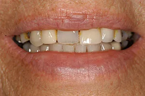 Patient's mouth before bridgework to replace a removable partial denture
