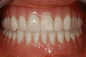 Patient's mouth after new dentures