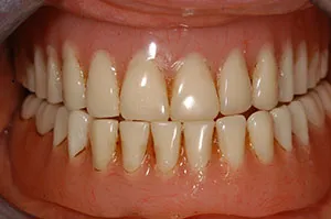Patient's mouth with old dentures