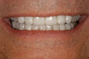 Patient's mouth after full-mouth rehabilitation