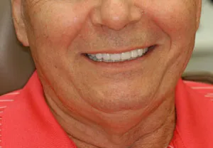 Patient's smile after full-mouth rehabilitation