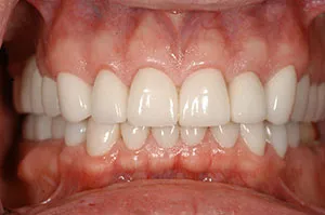 Patient's teeth after full-mouth rehabilitation