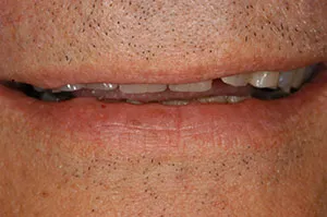 Patient's mouth before full-mouth rehabilitation