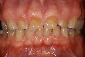 Patient's teeth before full-mouth rehabilitation