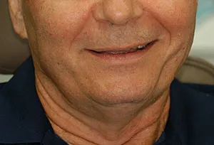Patient's smile before full-mouth rehabilitation