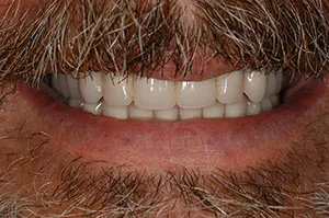 Patient's mouth after immediate dentures