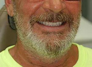Patient's smile after immediate dentures