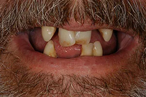 Patient's mouth before immediate dentures
