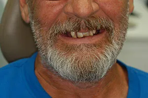 Patient's smile before immediate dentures