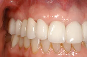 Patient's mouth after implant crowns