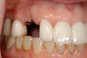 Patient's mouth before implant crowns