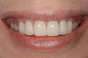 Patient's mouth after porcelain crowns on upper teeth