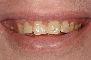 Patient's mouth before porcelain crowns on upper teeth
