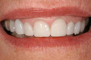 Patient's mouth after porcelain veneers
