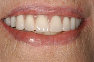 Patient's mouth after Teeth-in-a-Day
