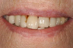 Patient's mouth before Teeth-in-a-Day