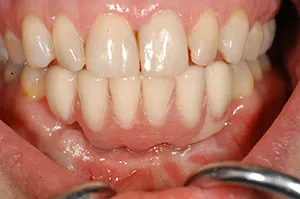 Patient's mouth with teeth and gum restored after facial trauma