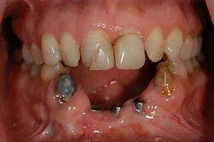 Patient's mouth with teeth and gum lost due to facial trauma