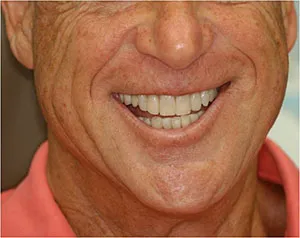 Patient's smile after closing black triangles