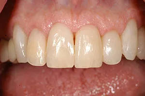 Patient's mouth after closing black triangles