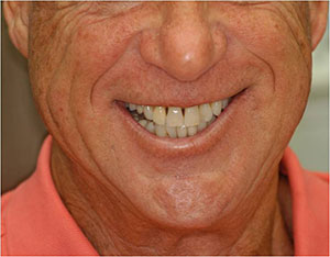 Patient's smile before closing black triangles