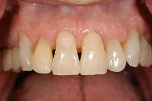 Patient's mouth before closing black triangles