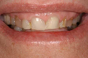 Patient's mouth before porcelain veneers