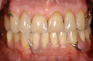 Patient's mouth after removable partial dentures