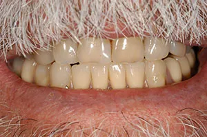 Patient's mouth after removable partial dentures