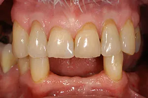 Patient's mouth before removable partial dentures
