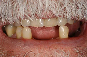 Patient's mouth before removable partial dentures
