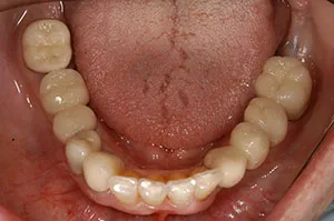 Patient's mouth with multiple dental implants with crowns
