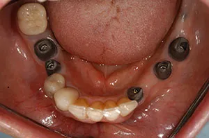 Patient's mouth with multiple dental implants without crowns
