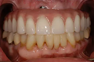 Patient's mouth after Teeth-in-a-Day