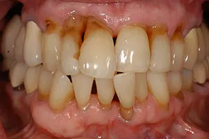 Patient's mouth before Teeth-in-a-Day