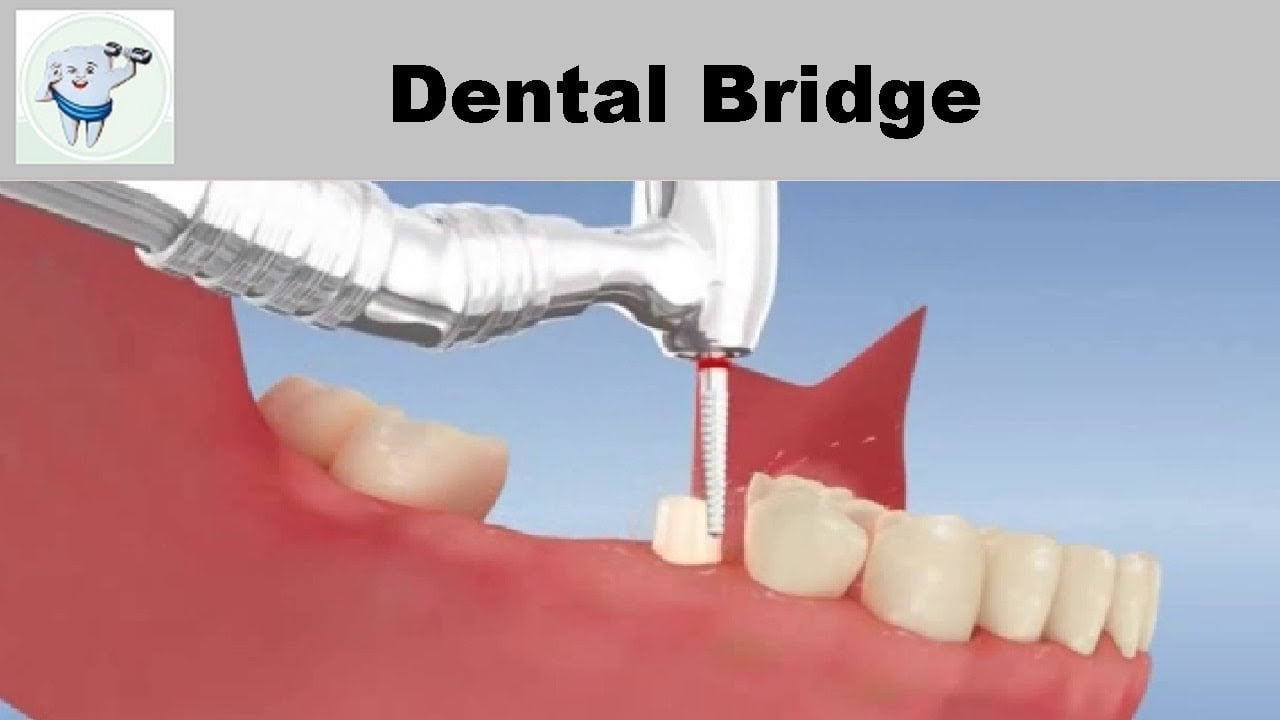 Dental Bridge Animation 3D Video Thumbnail