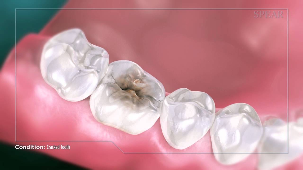 Cracked Tooth Video Thumbnail