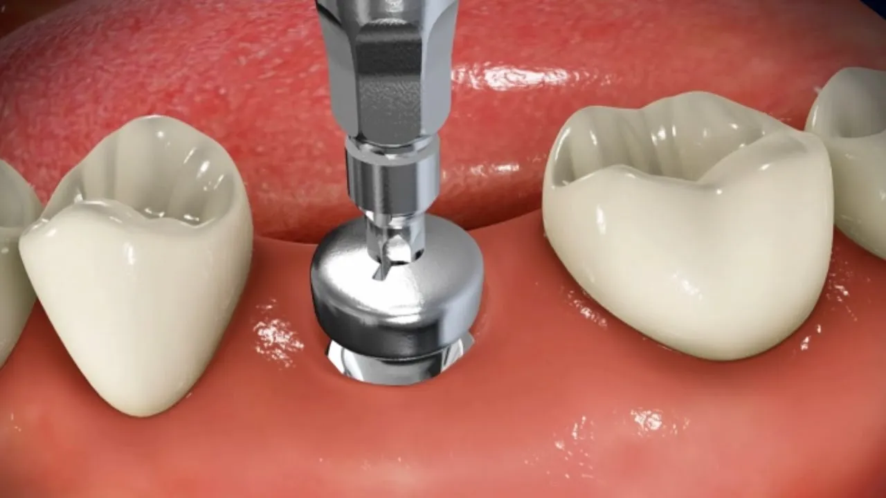 What Occurs During Implant Surgery Video Thumbnail